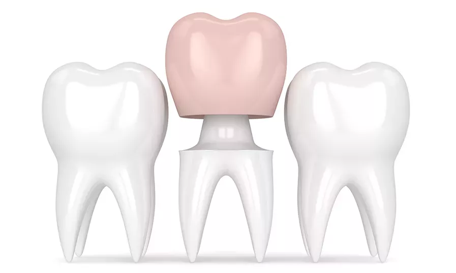 Teeth Crowns | Solomon Family Dentistry in Summerville & Mount Pleasant, SC