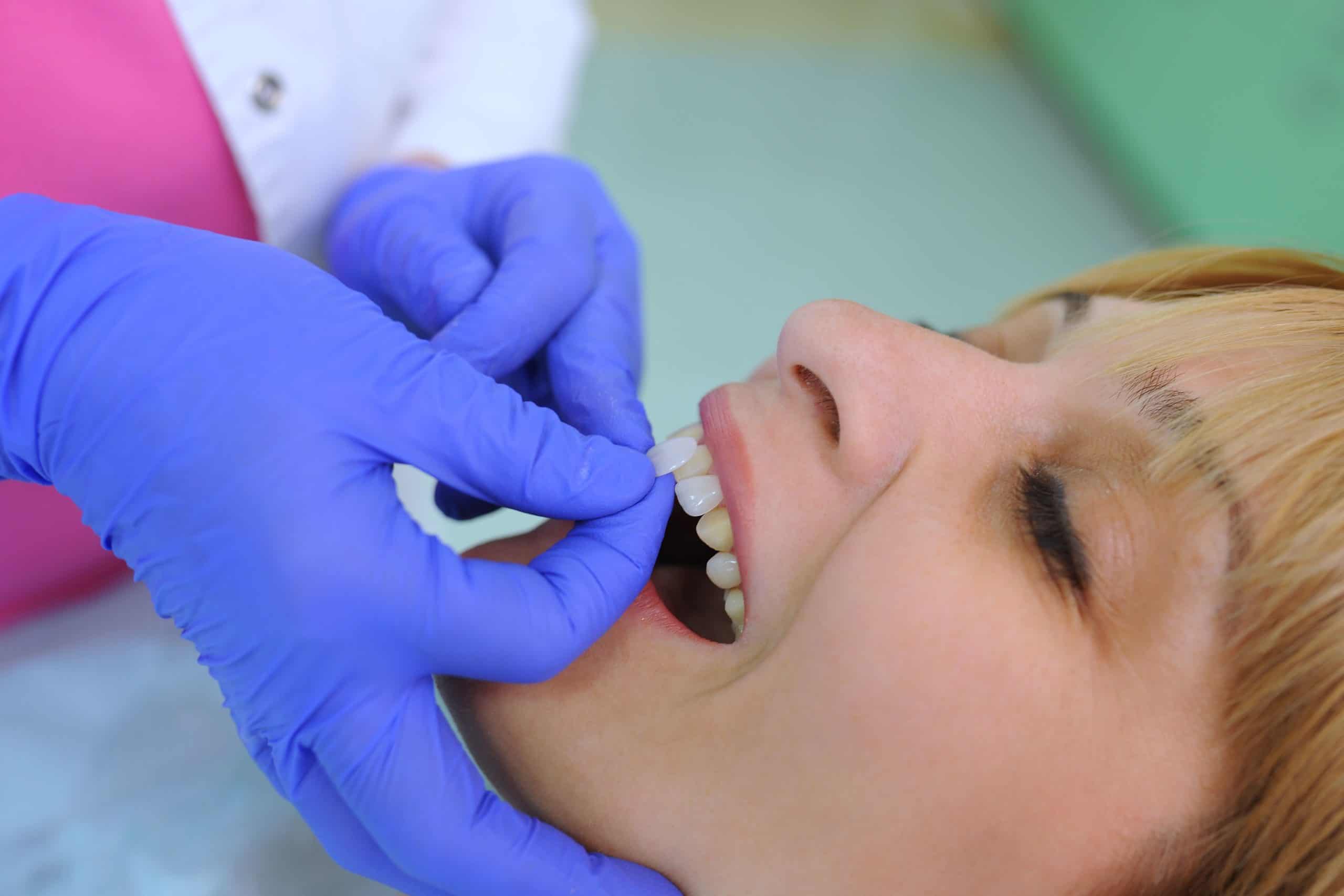 Wisdom-Teeth-By-Solomon-Dentistry-in-Summerville-SC