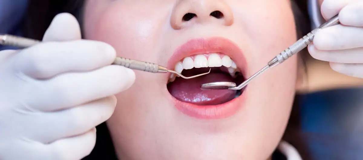 Dental Filling