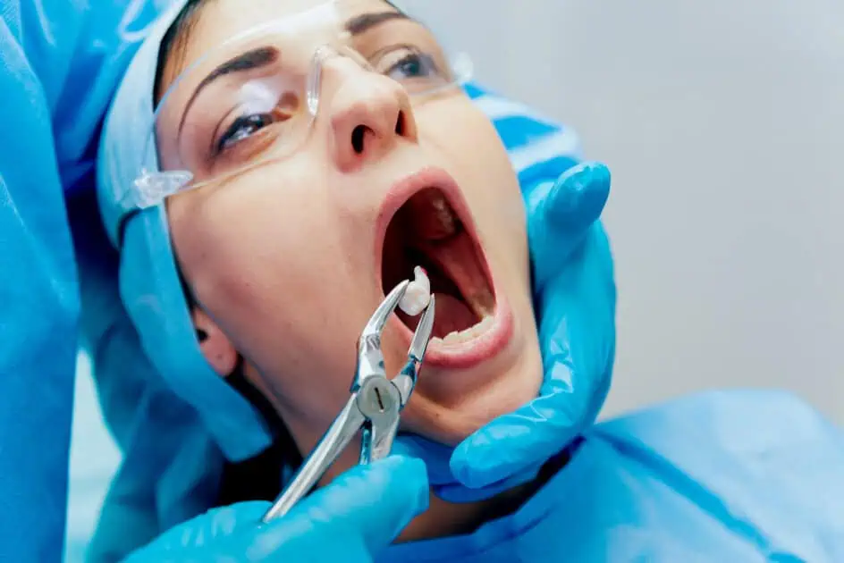 doctor remove teeth with Wisdom Teeth Removal in Summerville, SC