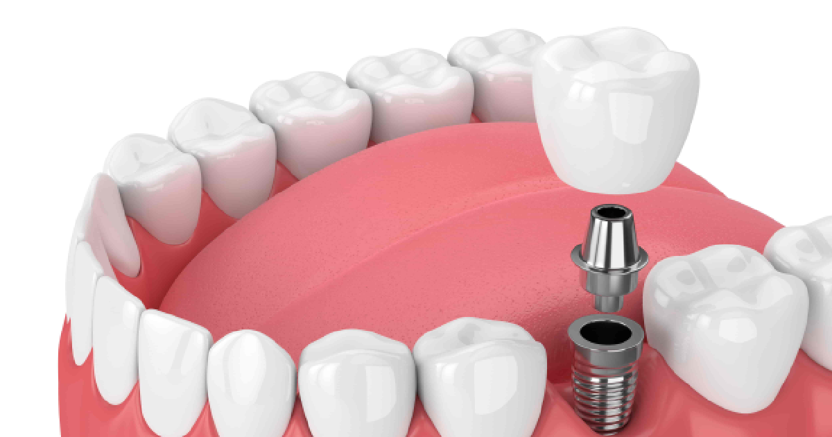 3D dental implant illustration with crown, abutment, and post – Sinus Lifts in Summerville & Mt. Pleasant, SC.