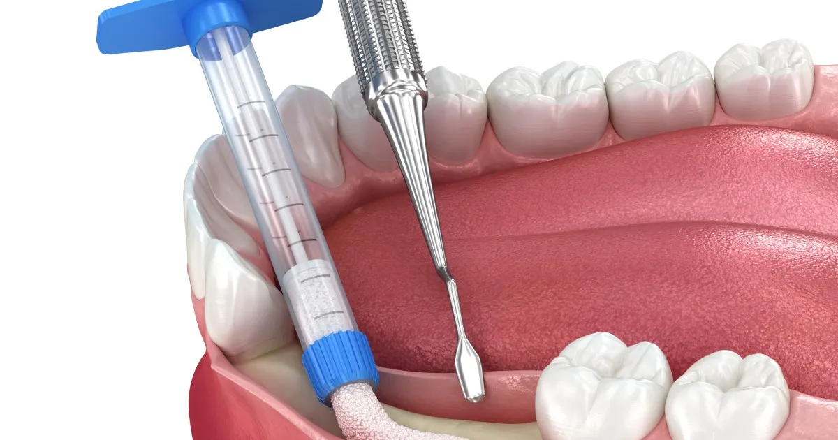 Bone Grafting In Summerville & Mount Pleasant
