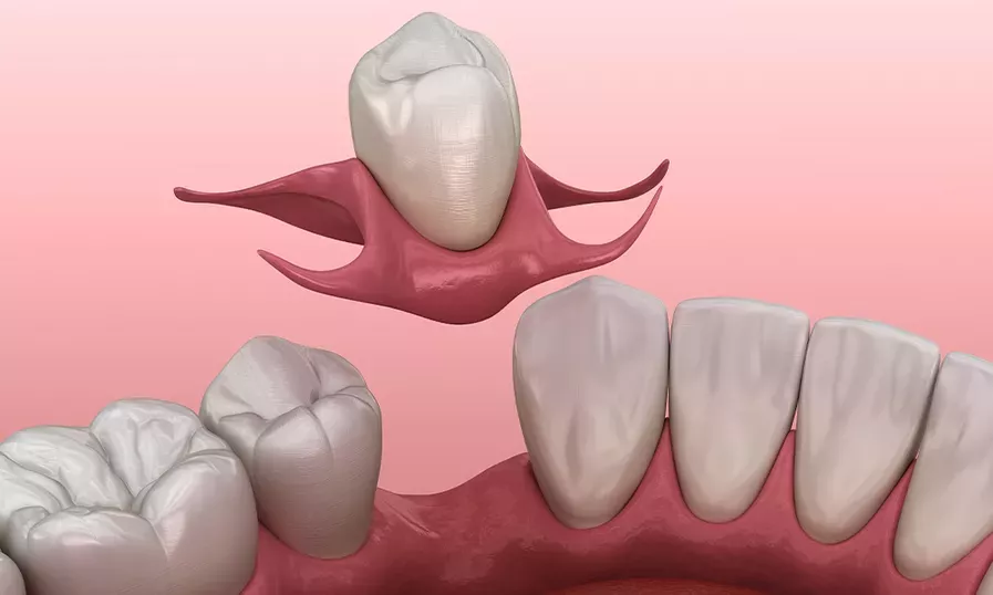 Teeth Partials | Solomon Family Dentistry in Summerville & Mount Pleasant, SC