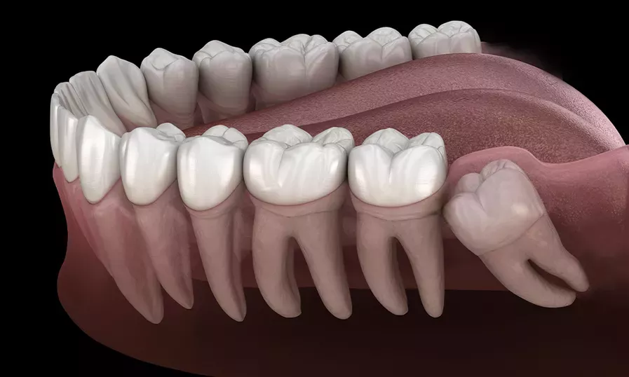 Wisdom Teeth | Solomon Family Dentistry in Summerville & Mount Pleasant, SC