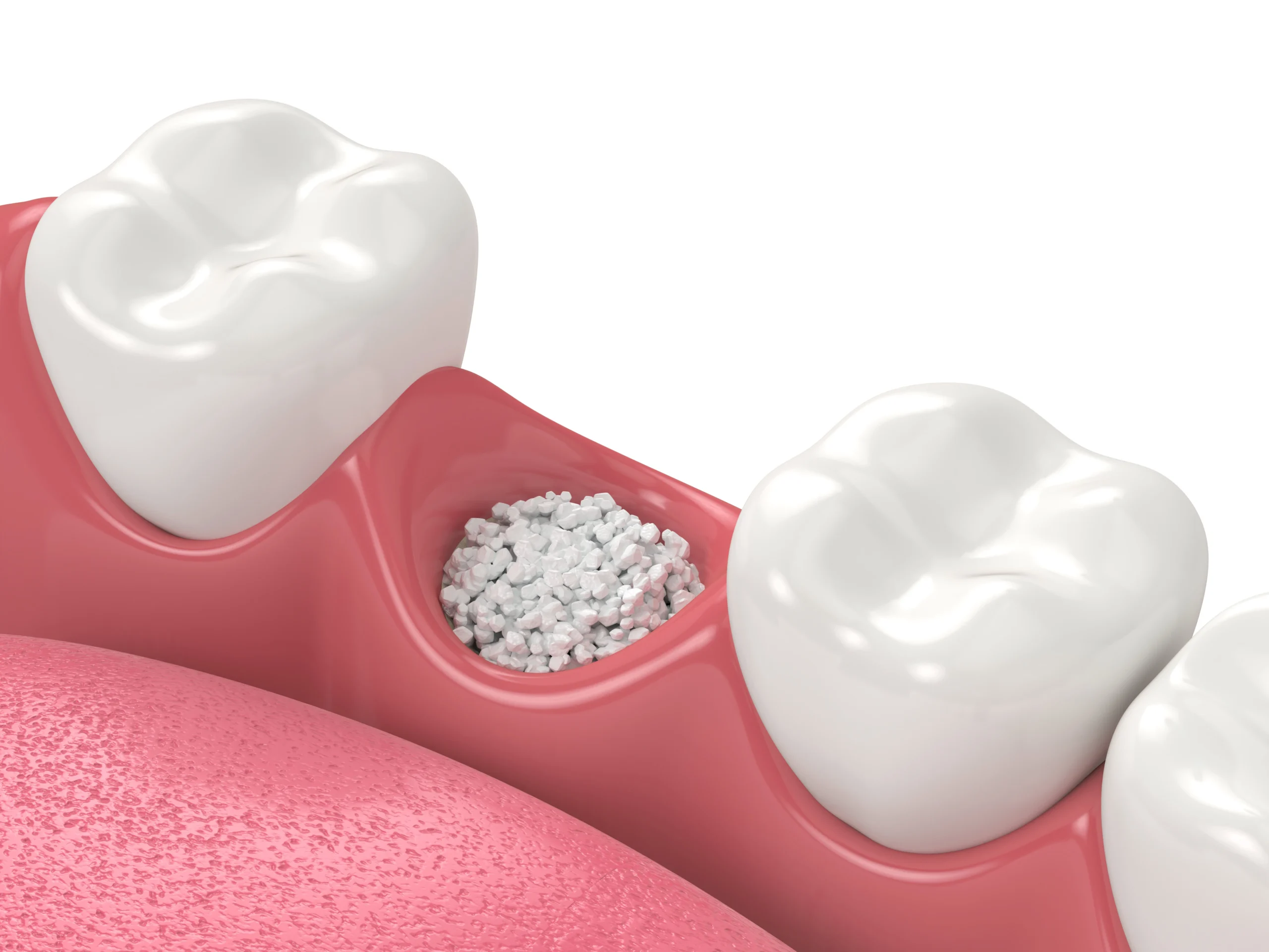 Bone grafting for tooth | Solomon Family Dentistry in Summerville, SC