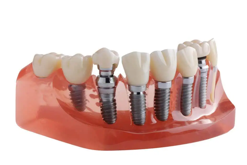 Fixed Hybrid Dentures by Solomon Family Dentistry in Summerville, SC