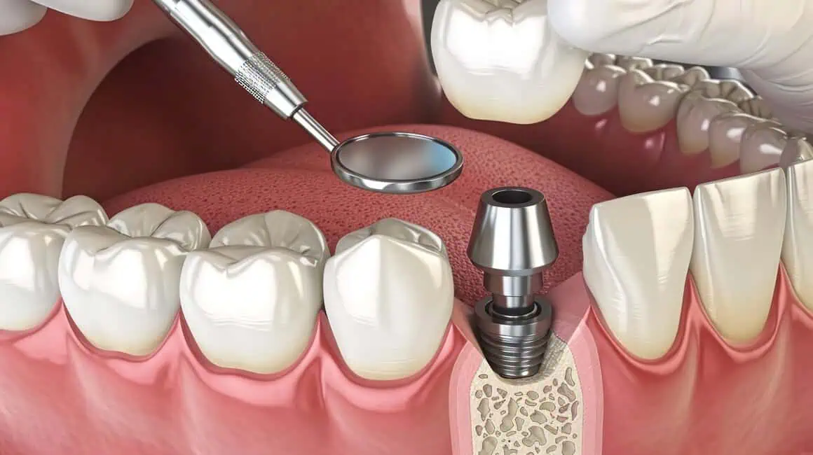 Bone Grafts by Solomon Family Dentistry in Summerville, SC