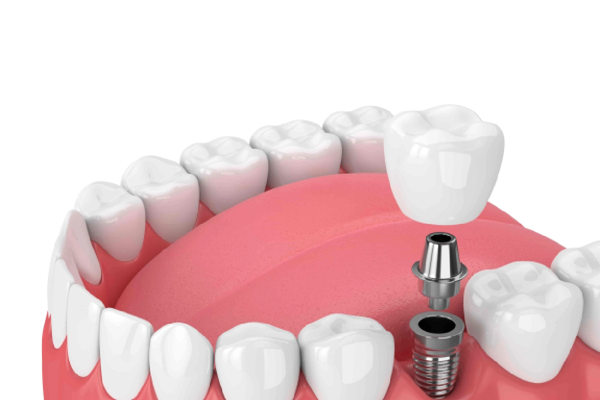 3D illustration of a dental implant, abutment, and crown showing the components used to replace a missing tooth.