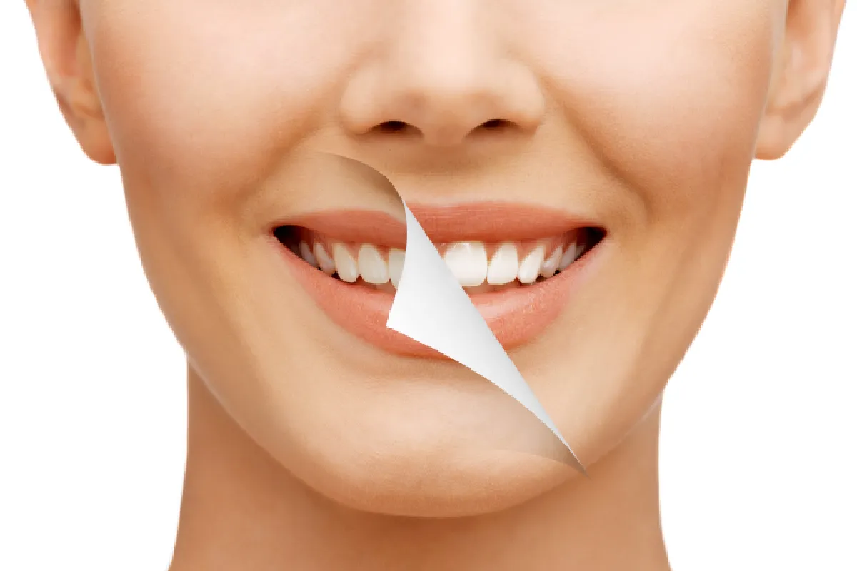 Teeth whitening results at Solomon Family Dentistry Summerville & Mount Pleasant South Carolina