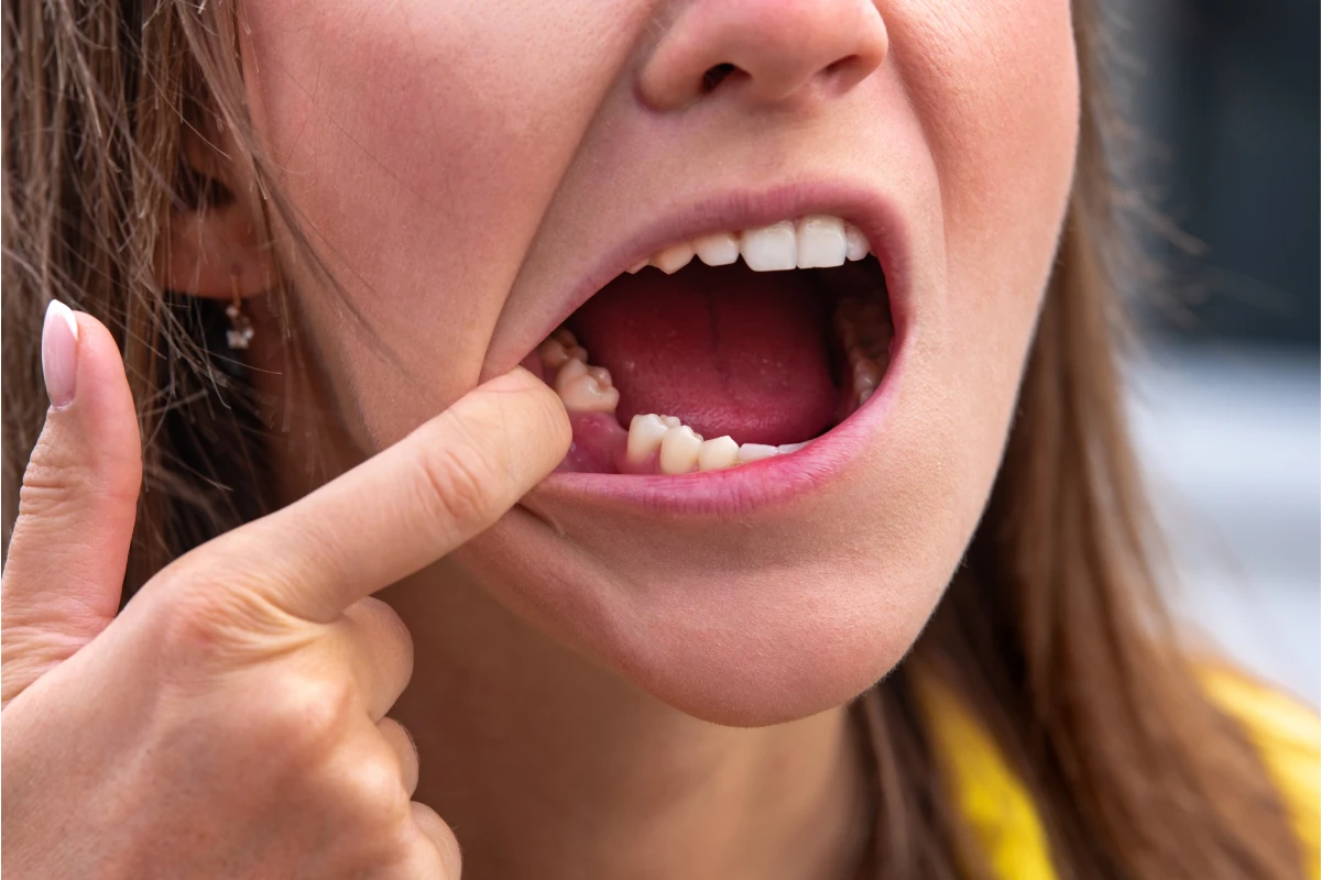 Patient showing a missing lower tooth before dental implant treatment to restore natural chewing function.
